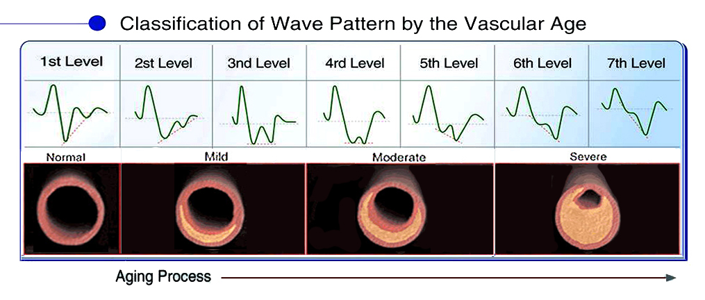 picture showing the change in wave form vs blocking of an artery